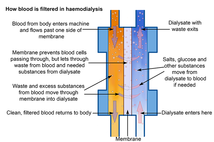 Diagram showing how the dialysate is filtered away from the blood stream. Dialysate exits the machine and cleaned blood is sent back to the body